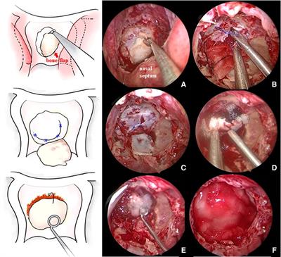Application of dural suturing in the endoscopic endonasal approach to the sellar region